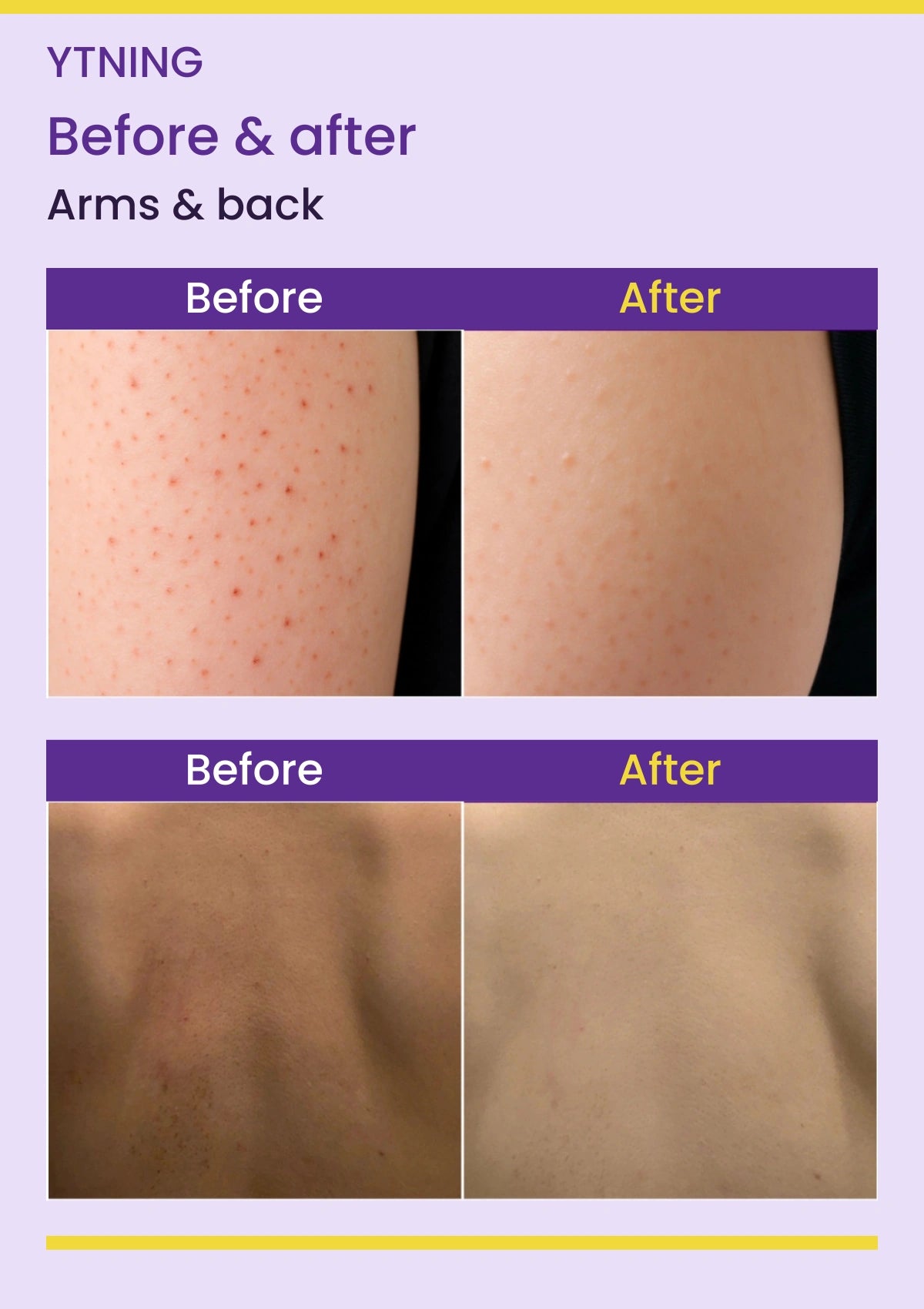 YTNING Scaling Toning Scrub Wash before-and-after arms & back photographs with readable English labels